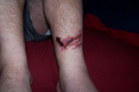 2003 Jeep TJ - Close-up of a leg injury with exposed tissue and bleeding.