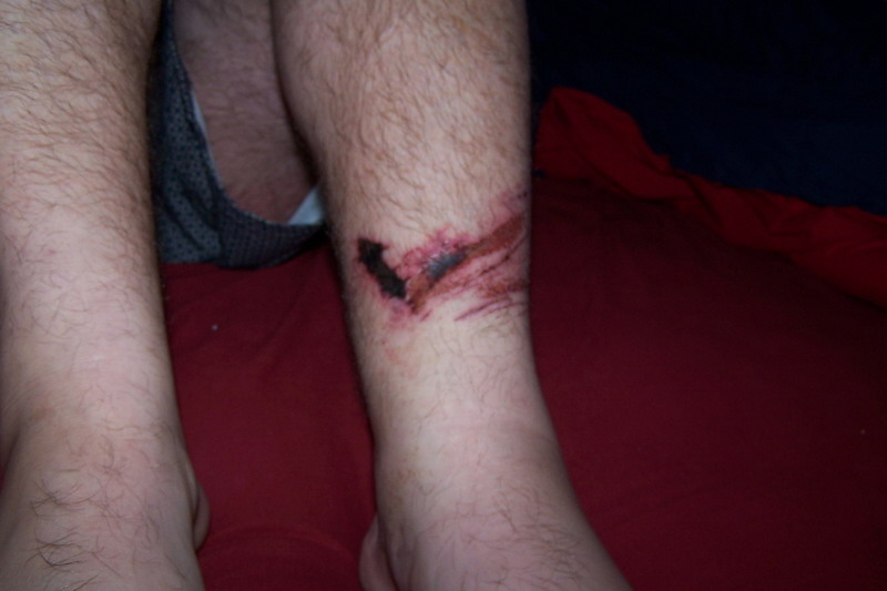 Human leg with a deep wound on the shin, showing torn skin and blood