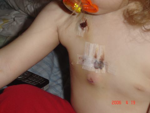 1993 Ford Bronco - Child's chest showing medical treatment with tape and bandages over wounds.