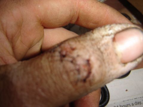 1992 Ford Bronco - Close-up of an injured finger with cuts and dirt. SuperMotors logo visible.