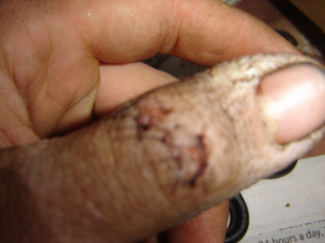 Close-up of an injured finger with cuts and dirt. SuperMotors logo visible