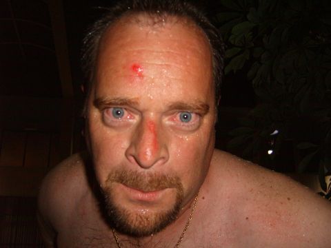 1993 Ford Bronco - A close-up portrait of a man with visible injuries to his face and forehead.