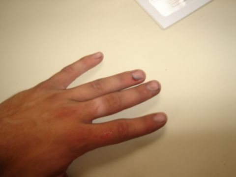 1997 Ford Probe - A hand with an injured finger and abrasions is visible against a plain background.