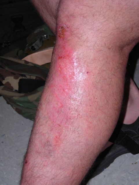 2003 Jeep TJ - Close-up of a human leg with visible skin abrasions and redness.