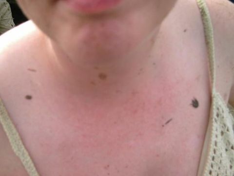1986 Ford Bronco - A close-up view of a person's chest and neck area, showing skin with moles.