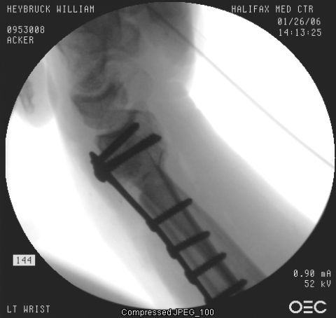 1989 Ford Bronco - This medical image shows a left wrist with surgical plates and screws, likely after a fracture repair.