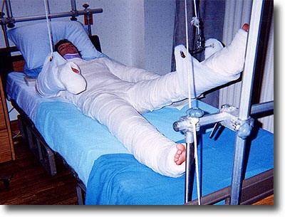 1993 Ford Bronco - Patient recovering in a hospital bed, fully encased in casts and traction apparatus.