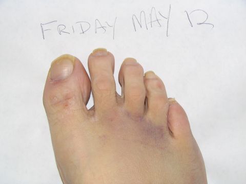 1986 Pontiac Fiero - A close-up view of a person's toes, showing bruising, with the date 'FRIDAY MAY 12' written on paper in the background.
