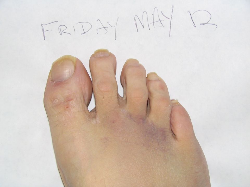 Bruised toes with 'FRIDAY MAY 12' written above them. Supermotors.net logo in corner