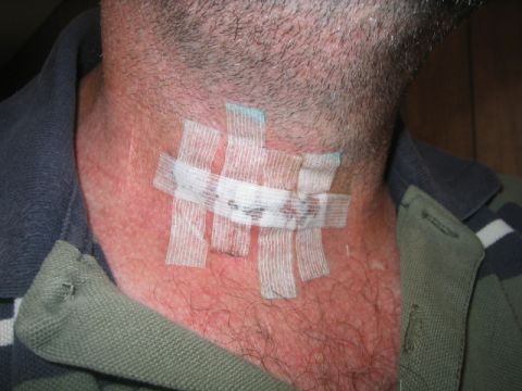 1973 Ford F-100 - Medical dressing applied to a neck, with website text visible in the corner.