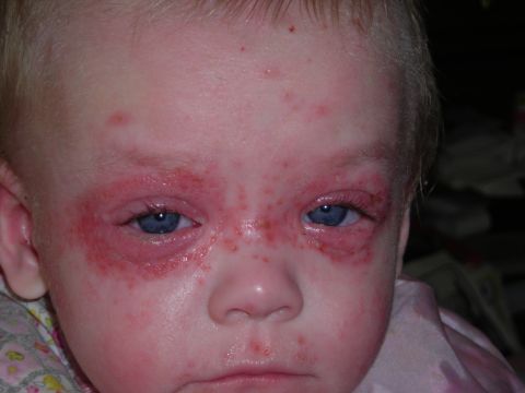 2003 Jeep TJ - This image shows a baby with a rash around their eyes and on their face.