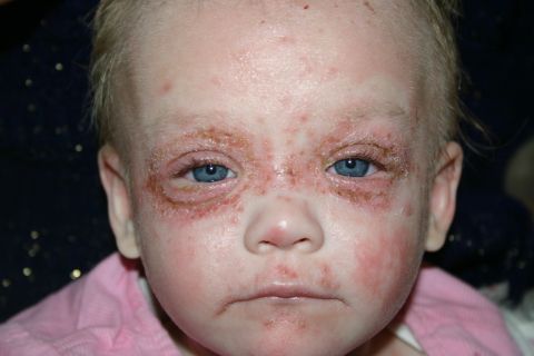 2003 Jeep TJ - A child's face shows signs of a skin condition, with redness and irritation around the eyes and cheeks.