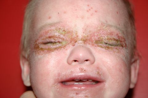 2003 Jeep TJ - A baby's face shows significant skin irritation and lesions, particularly around the eyes and mouth.