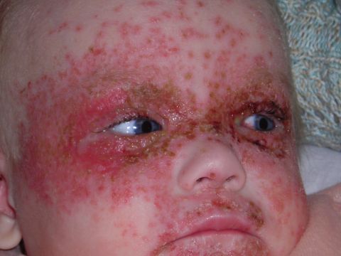 2003 Jeep TJ - A baby's face shows significant redness and scabbing, indicating a severe skin condition.