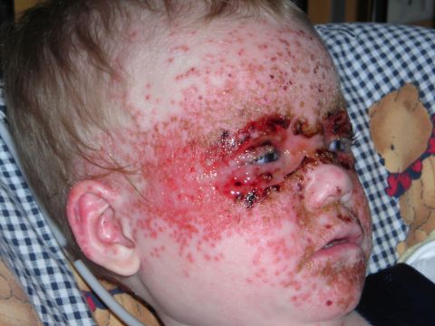 2003 Jeep TJ - A close-up view of a child's face, showing significant skin irritation and lesions.