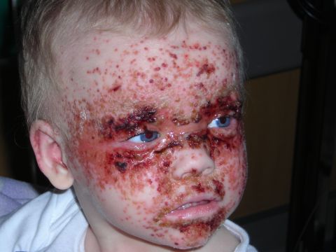 2003 Jeep TJ - A child's face is covered in scabs and lesions, with blue eyes visible.