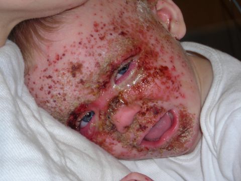 2003 Jeep TJ - This image shows a child's face covered in numerous red spots and scabs, indicating a significant skin ailment.