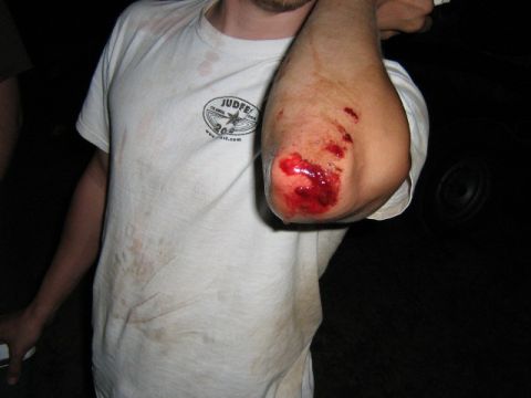 1986 Ford Bronco - A person shows a bloody elbow after an apparent accident.