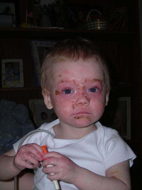 2003 Jeep TJ - Child with rash on face and hands.