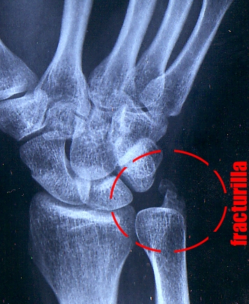 1992 Ford Explorer - An X-ray image of a fractured wrist, annotated with red circles and text indicating the injury.