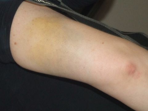 1979 Ford Bronco - A close-up view of a bruised arm, showing discoloration and a red mark.