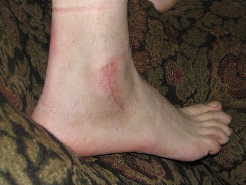 1986 Pontiac Fiero - A close-up view of a human ankle and foot, showing some redness on the skin, placed on a textured surface.