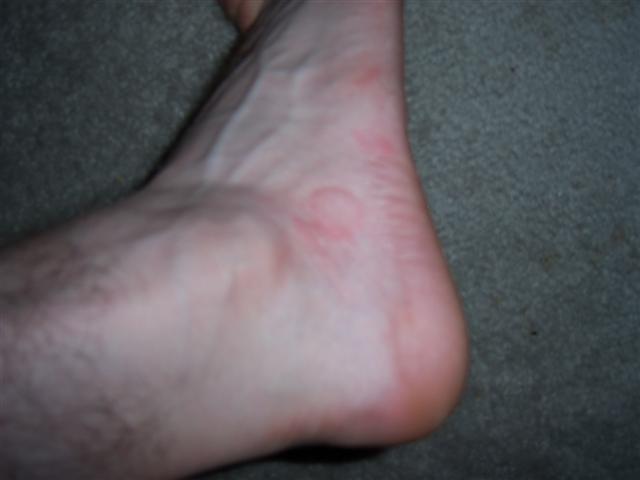 Close-up of a human foot with red marks on the ankle area
