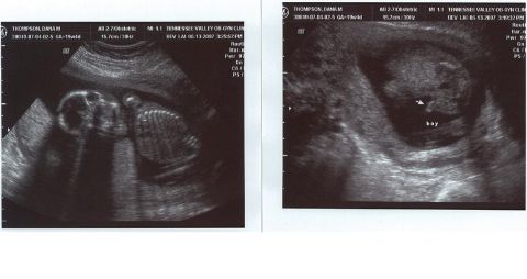 1988 Ford Bronco - These ultrasound images display fetal development and medical information.