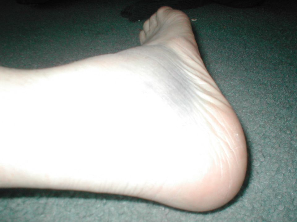 Bruised foot on carpet