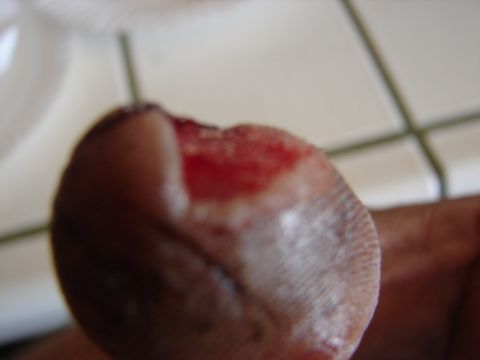 1973 Ford Ranchero - A close-up view of a finger with a wound on its tip.