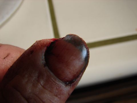 1973 Ford Ranchero - A close-up view of an injured thumb shows significant damage to the nail and surrounding tissue.
