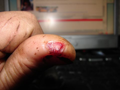 1973 Ford Ranchero - Close-up of an injured thumb with a bloody wound, in front of a computer monitor.