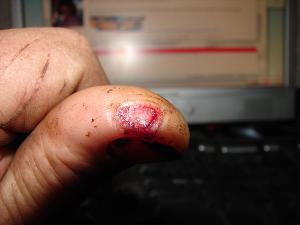 Close-up of a person's injured, bleeding thumb in front of a computer monitor