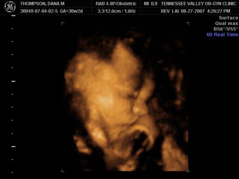 1988 Ford Bronco - This is a 3D ultrasound image showing a fetus at 30 weeks gestation.