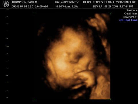1988 Ford Bronco - This is a 4D real-time ultrasound image of a fetus.