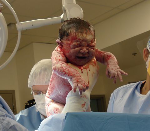 2000 Ford Crown Victoria - A newborn baby, freshly delivered and covered in vernix and blood, is presented by medical professionals in an operating room.
