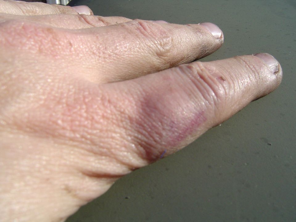 Decided to hit my finger with the "Dead blow"