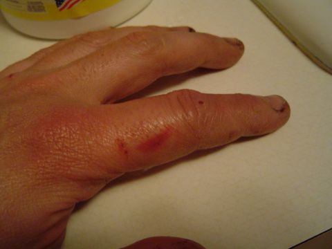 1978 Ford Bronco - Hit my finger a few more times, does it look normal?