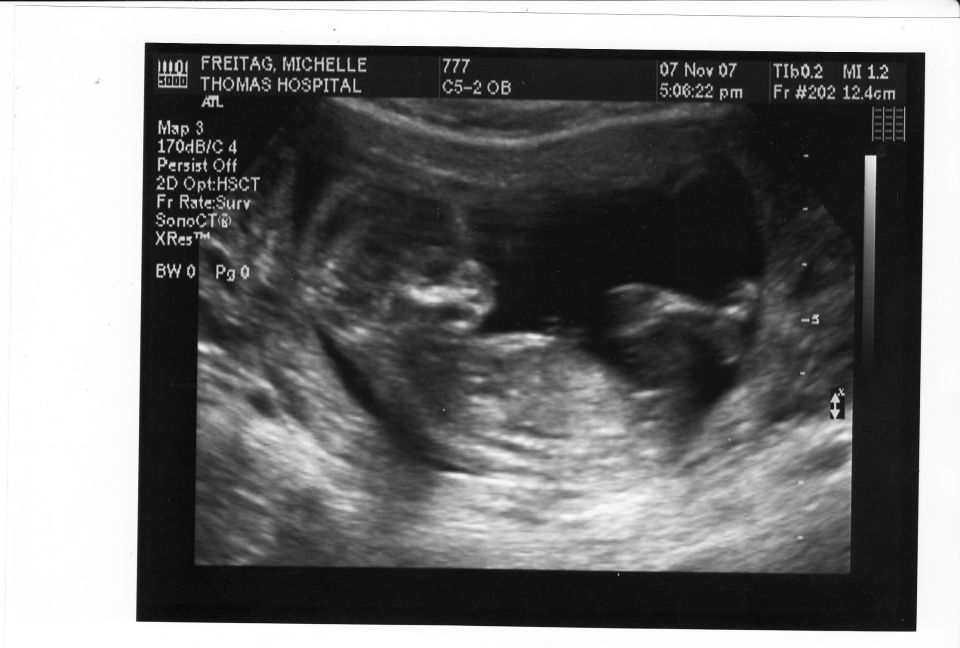 Ultrasound image showing a fetus, with text indicating it is from Thomas Hospital on Nov 07, 2007