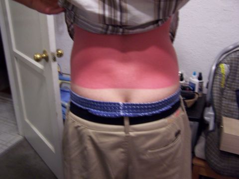 2007 Ford Ranger - A person's back shows a clear line from a sunburn, indicating a recent exposure to the sun.