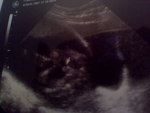 1987 Suzuki Samurai - This ultrasound image does not depict a 1987 Suzuki Samurai.