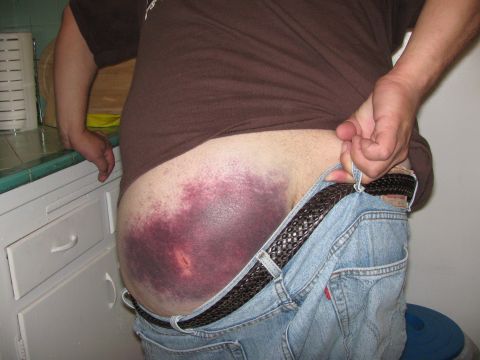 1987 Suzuki Samurai - A large, discolored bruise covers the hip area of a person wearing jeans and a brown t-shirt.