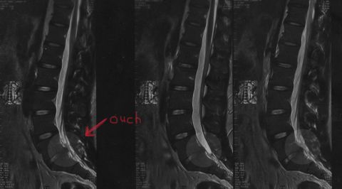 1989 Mazda MX-6 - Medical imaging document showing spinal anatomy with a handwritten annotation indicating pain.