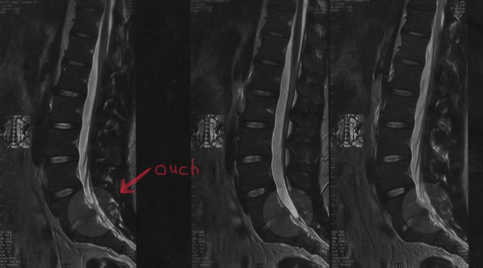 MRI scans of a spine with 'ouch' written on one