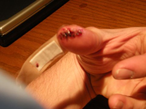 1993 Ford Bronco - A close-up shows an injured thumb with stitches and a bandage, resting on a wooden table.