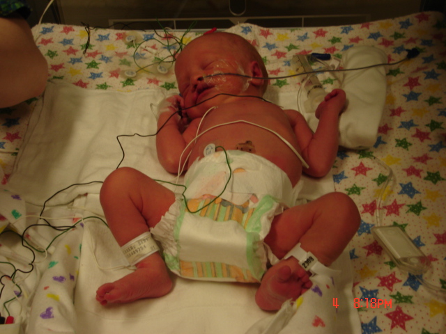 Newborn baby with medical tubes and wires in an incubator, wearing a diaper and identification bands