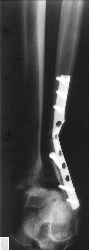 1991 Ford Explorer - Broke my leg AGAIN in Aug, 2002. on a dirt bike this time.