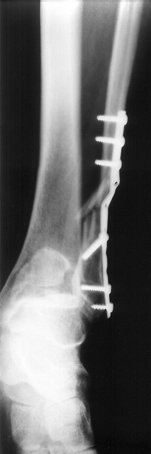 1991 Ford Explorer - Just another x-ray i scanned.