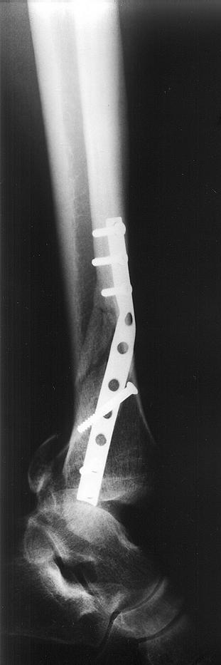 1991 Ford Explorer - Another x-ray