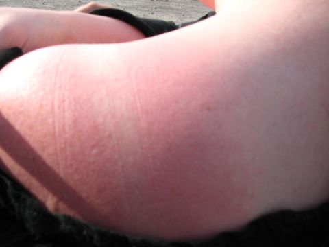 1978 Ford Bronco - A person's arm shows signs of sunburn with red, textured skin.